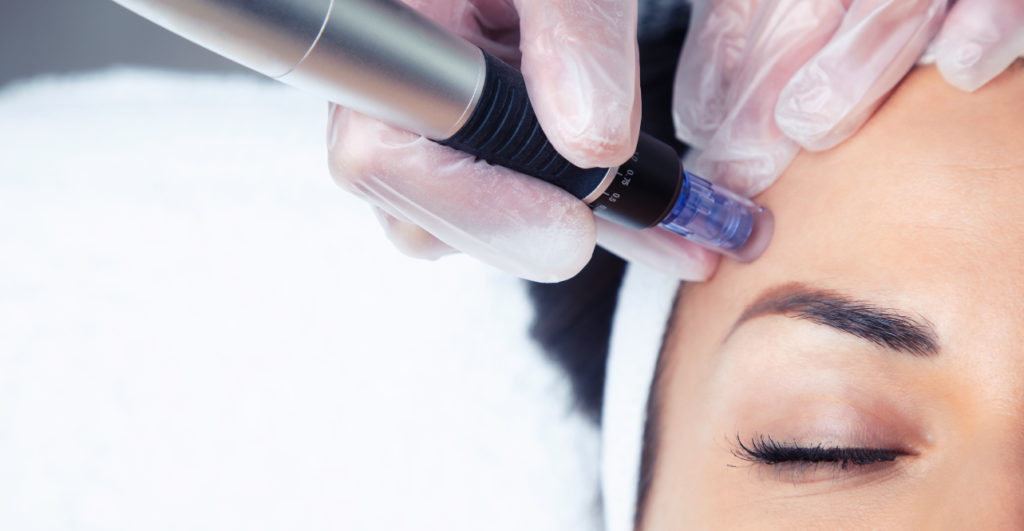 GlowNGo Microneedling Treatment