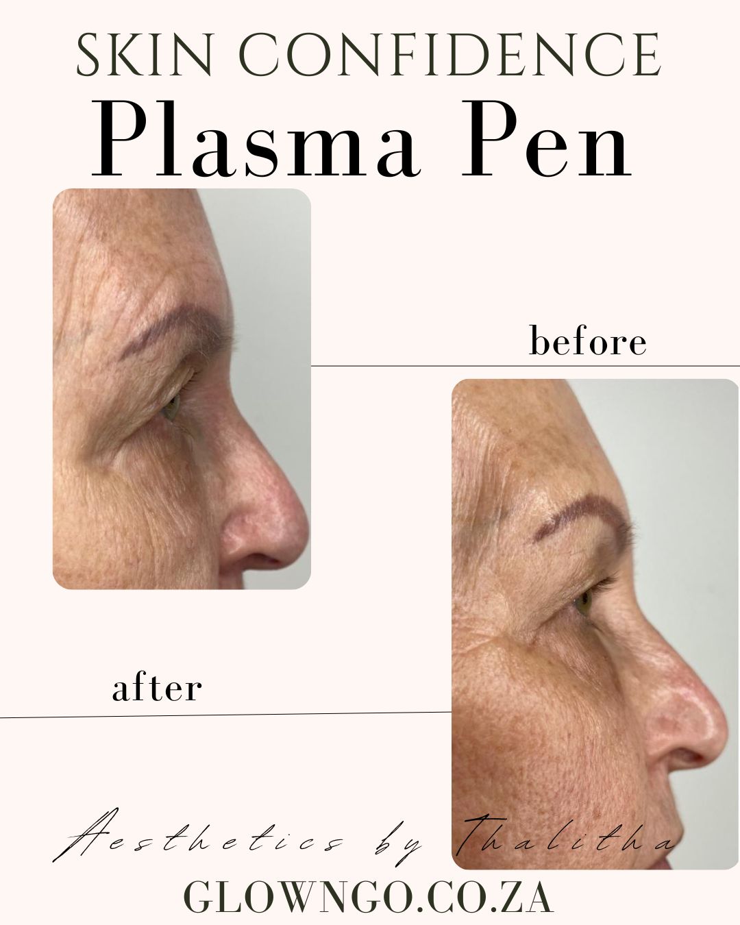 Laser 10