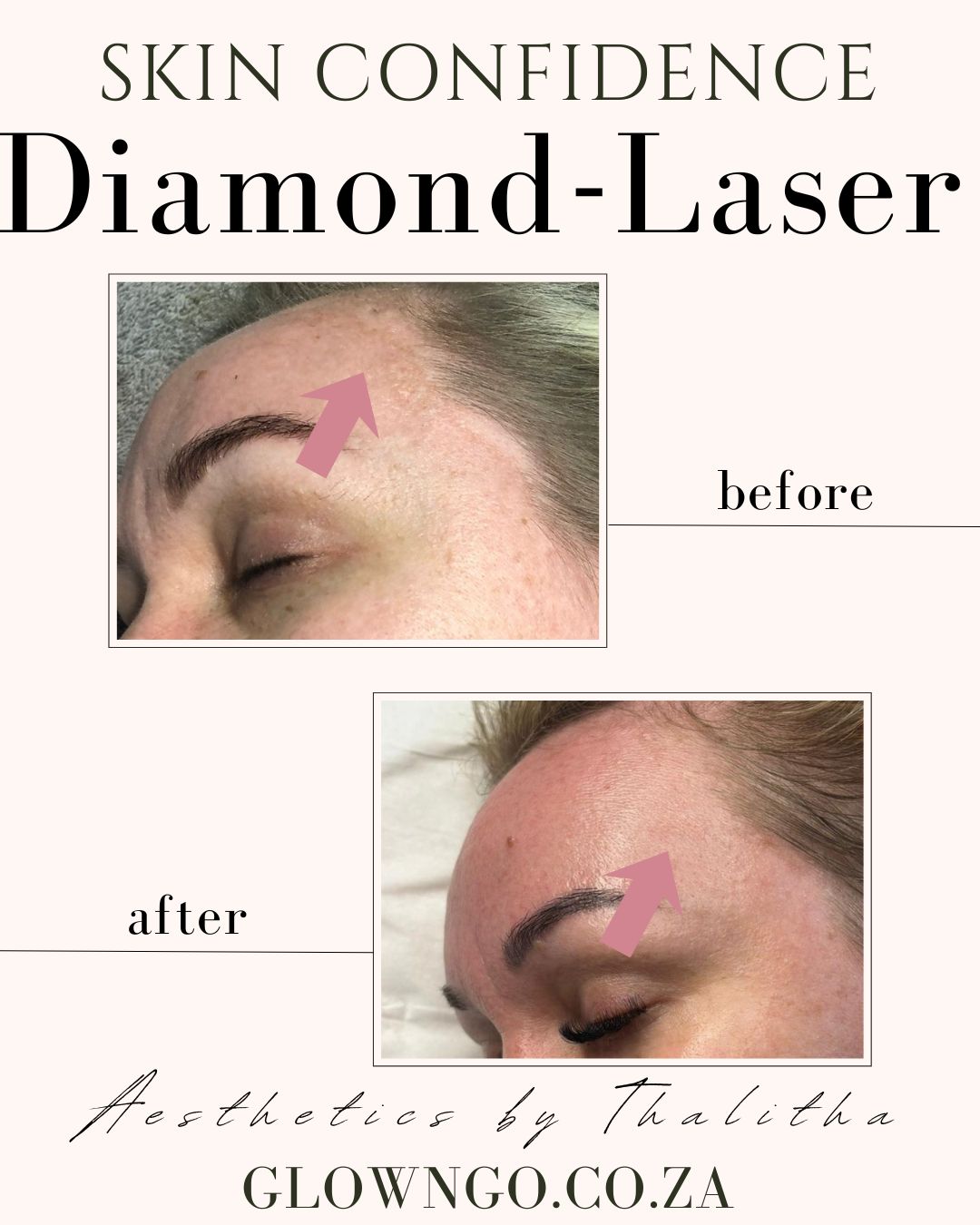 Laser 2